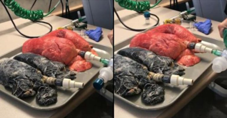 Sykepleier deler et sjokkerende bilde: Her ser du forskjellen mellom en frisk lunge og lungen til en røyker!