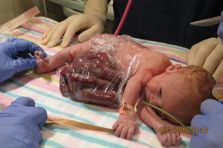 Teddy ble født med tarmene på utsiden av kroppen – Legene tilrådet abort, men se på han nå